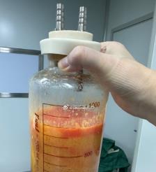 赤壁水动力吸脂手术要做多久？